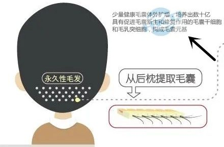別攔我！我要取下禿頂“緊箍咒”